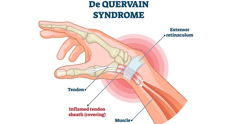 de Quervain syndrome