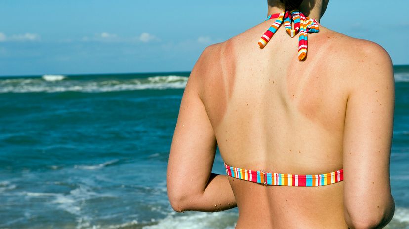 A new study found another possible unappetizing consequence of late night dining: an increased risk for sunburn. jcarillet/Getty Images