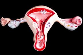This model of the uterus and ovaries shows common uterine problems, including endometriosis, adhesions, fibroids and cysts, but adenomyosis is rarely represented on such models, perhaps because the cause of the condition is not fully understood.