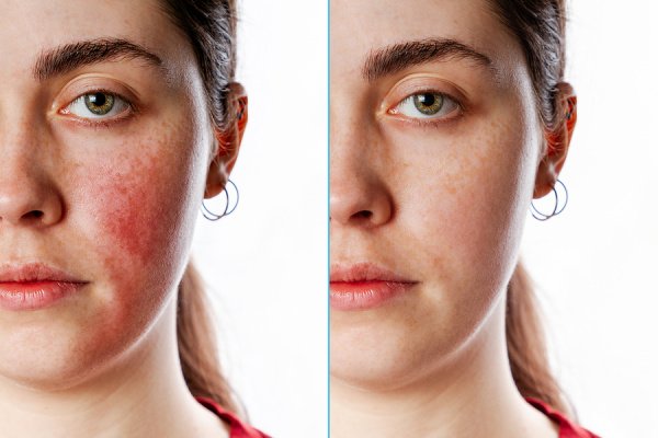 7 Rosacea Remedies that Work | If you want to know how to get rid of rosacea, this post will help! We're sharing the symptoms and causes of rosacea, the best DIY natural remedies and skincare products for rosacea, and beauty tips and step by step makeup tutorials to teach you how to hide rosacea. If you have rosacea on your nose, cheeks, neck, or all over your face, these tips and ideas will teach you how to treat it, how to prevent it from getting worse, and how to cover it up!
