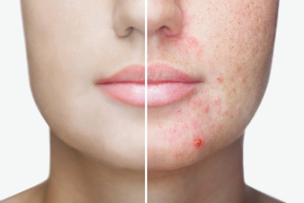 How to Get Rid of Acne Scars | If you want to know how to get rid of acne scars on the face, body, back, and other parts of your body fast, this post is for you! We’re sharing 5 DIY homemade natural remedies for acne scars using ingredients like apple cider vinegar, aloe vera, coconut oil, and honey, as well as 5 skin care products that fade acne scars fast. While these acne remedies won’t work overnight, you’ll probably start seeing results in a week! #acne #acnescars #getridofacnescars