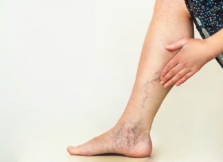 How to Get Rid of Varicose Veins: 9 Home Remedies That Work