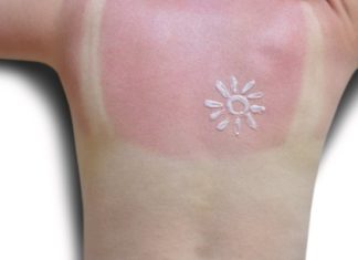 Too Much Sun! 8 Natural Sunburn Remedies That Work Fast