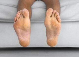 Tinea Pedis: 7 Remedies for Athlete’s Foot to Ease Symptoms