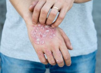 How to Get Rid of Psoriasis: 9 Tips and Remedies to Try